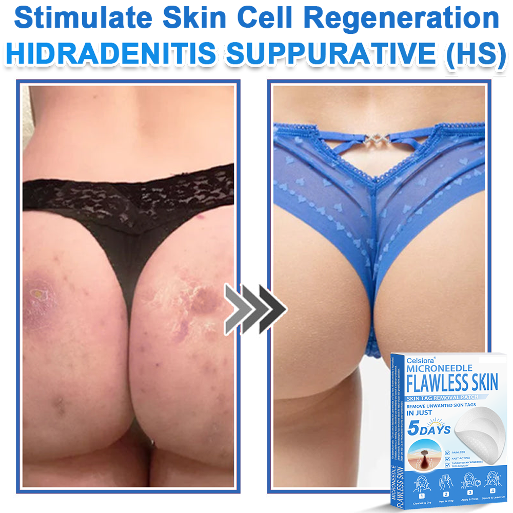 2-in-1 Microneedle & Hydrocolloid Patch | Raised Moles,Acne,  Flat Warts & Skin Tags Remover | Improves Wrinkles, Scars & Blemishes | Invisible Star Pimple Patches for Face & Body