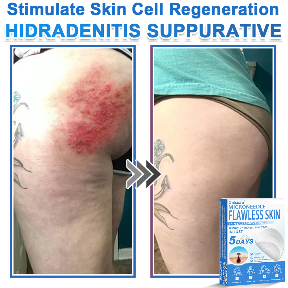 2-in-1 Microneedle & Hydrocolloid Patch | Raised Moles,Acne,  Flat Warts & Skin Tags Remover | Improves Wrinkles, Scars & Blemishes | Invisible Star Pimple Patches for Face & Body