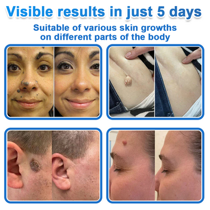 2-in-1 Microneedle & Hydrocolloid Patch | Raised Moles,Acne,  Flat Warts & Skin Tags Remover | Improves Wrinkles, Scars & Blemishes | Invisible Star Pimple Patches for Face & Body