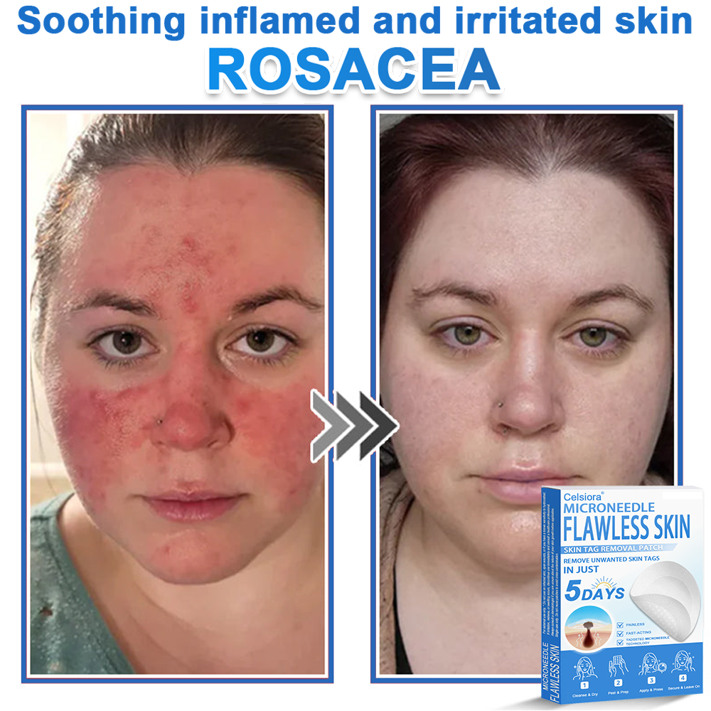 2-in-1 Microneedle & Hydrocolloid Patch | Raised Moles,Acne,  Flat Warts & Skin Tags Remover | Improves Wrinkles, Scars & Blemishes | Invisible Star Pimple Patches for Face & Body