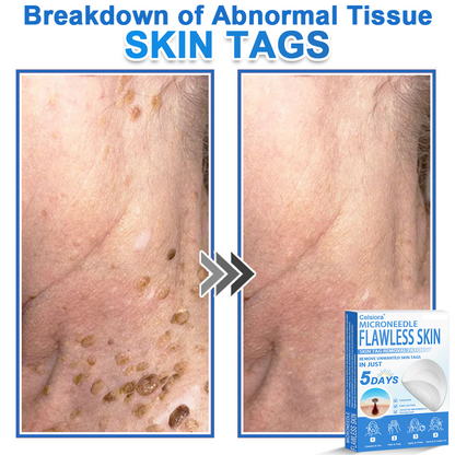 2-in-1 Microneedle & Hydrocolloid Patch | Raised Moles,Acne,  Flat Warts & Skin Tags Remover | Improves Wrinkles, Scars & Blemishes | Invisible Star Pimple Patches for Face & Body
