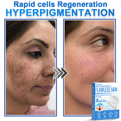 2-in-1 Microneedle & Hydrocolloid Patch | Raised Moles,Acne,  Flat Warts & Skin Tags Remover | Improves Wrinkles, Scars & Blemishes | Invisible Star Pimple Patches for Face & Body